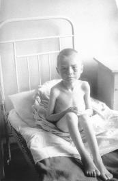 Девочка-дистрофик в больнице. Фото Н. Хандогина. Весна - лето 1942.